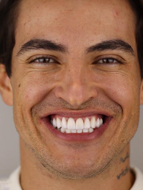 Paciente sorrindo com lentes em porcelana