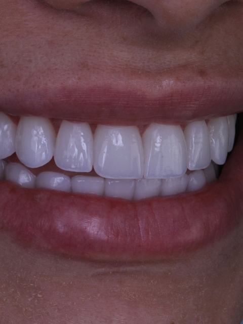 Detalhe de sorriso com lentes