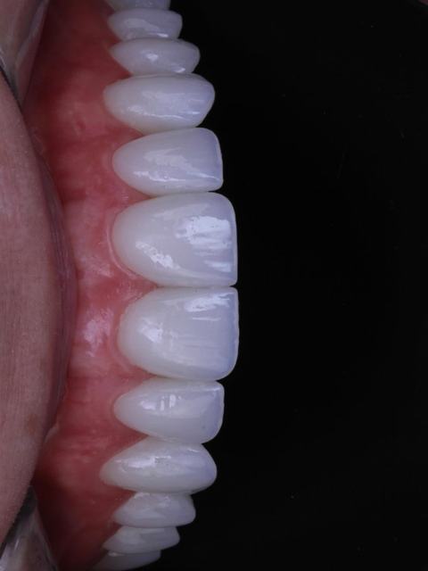 Detalhe de lentes de contato dental