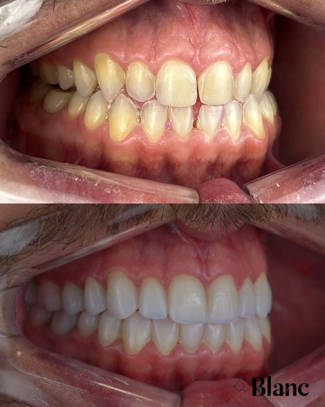 Arcadas antes e depois do tratamento