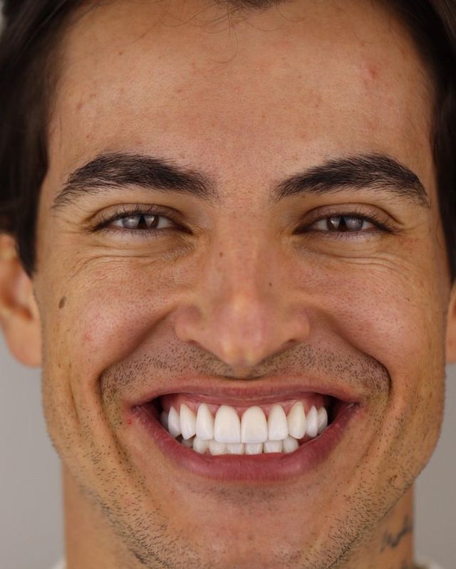 Paciente sorrindo com lentes em porcelana