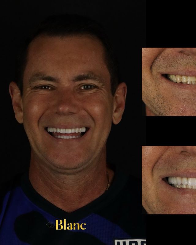 Paciente com o sorriso antes e depois das lentes