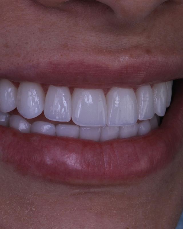 Detalhe de sorriso com lentes de porcelana