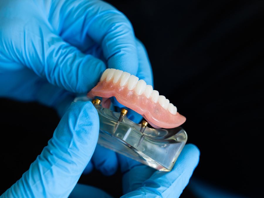 Prótese sobre implantes em modelo